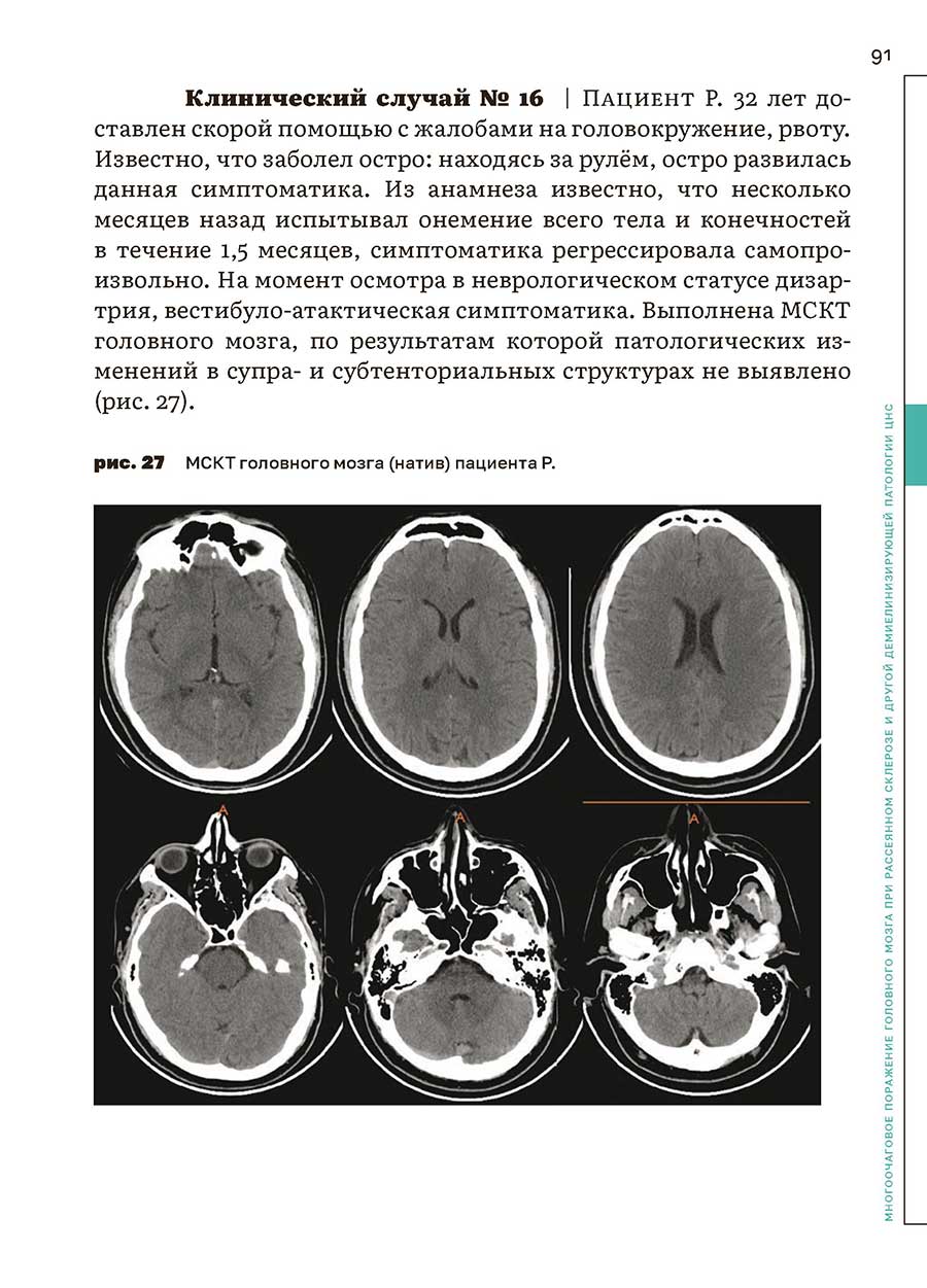 рис. 27 МСКТ головного мозга (натив) пациента Р.