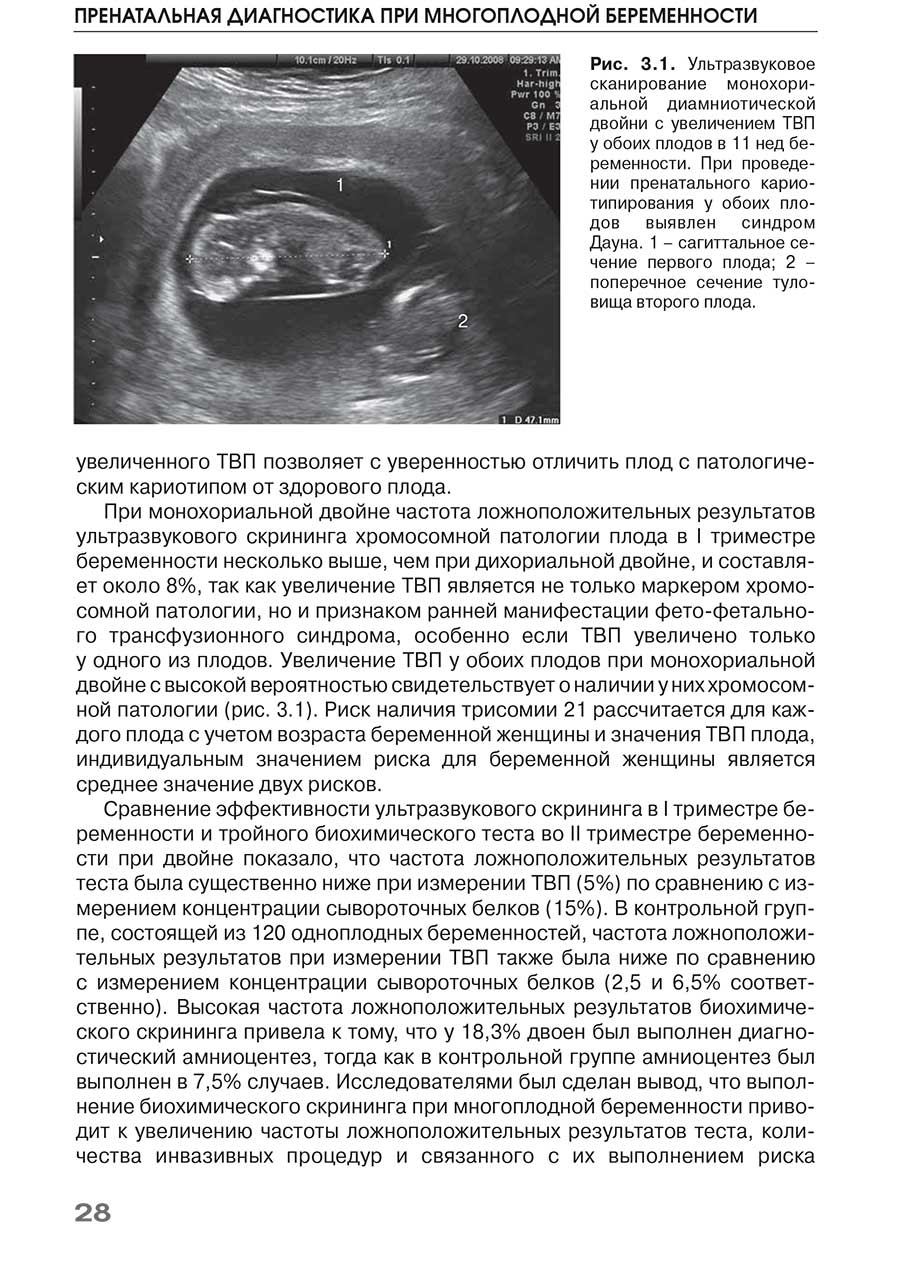 Рис. 3.1. Ультразвуковое сканирование монохориальной диамниотической двойни с увеличением ТВП