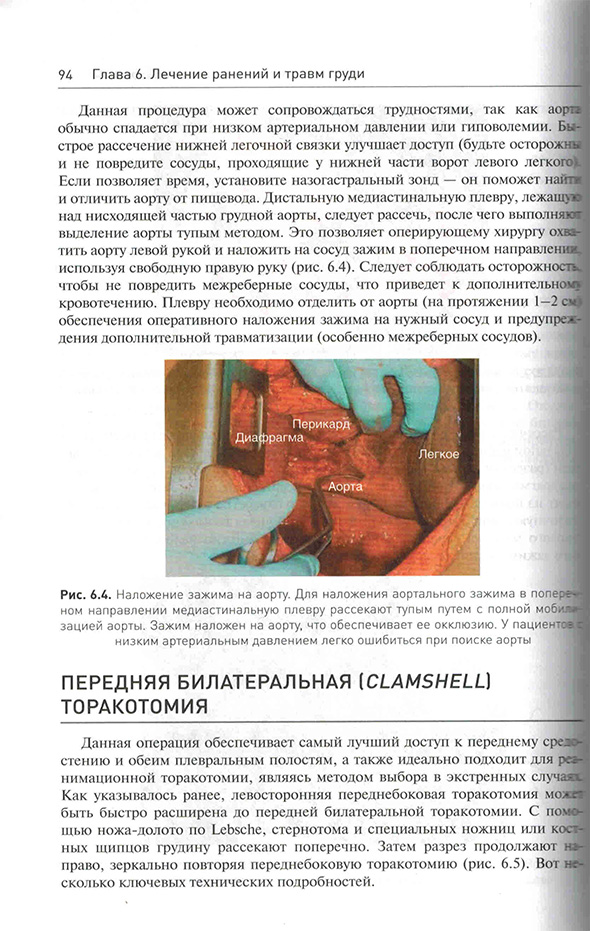 Наложение зажима на аорту Наложение зажима на аорту
