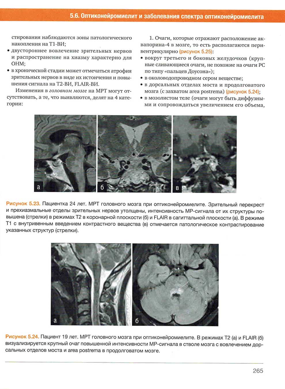 Рисунок 5.24. Пациент 19 лет. МРТ головного мозга при оптиконейромиелите.