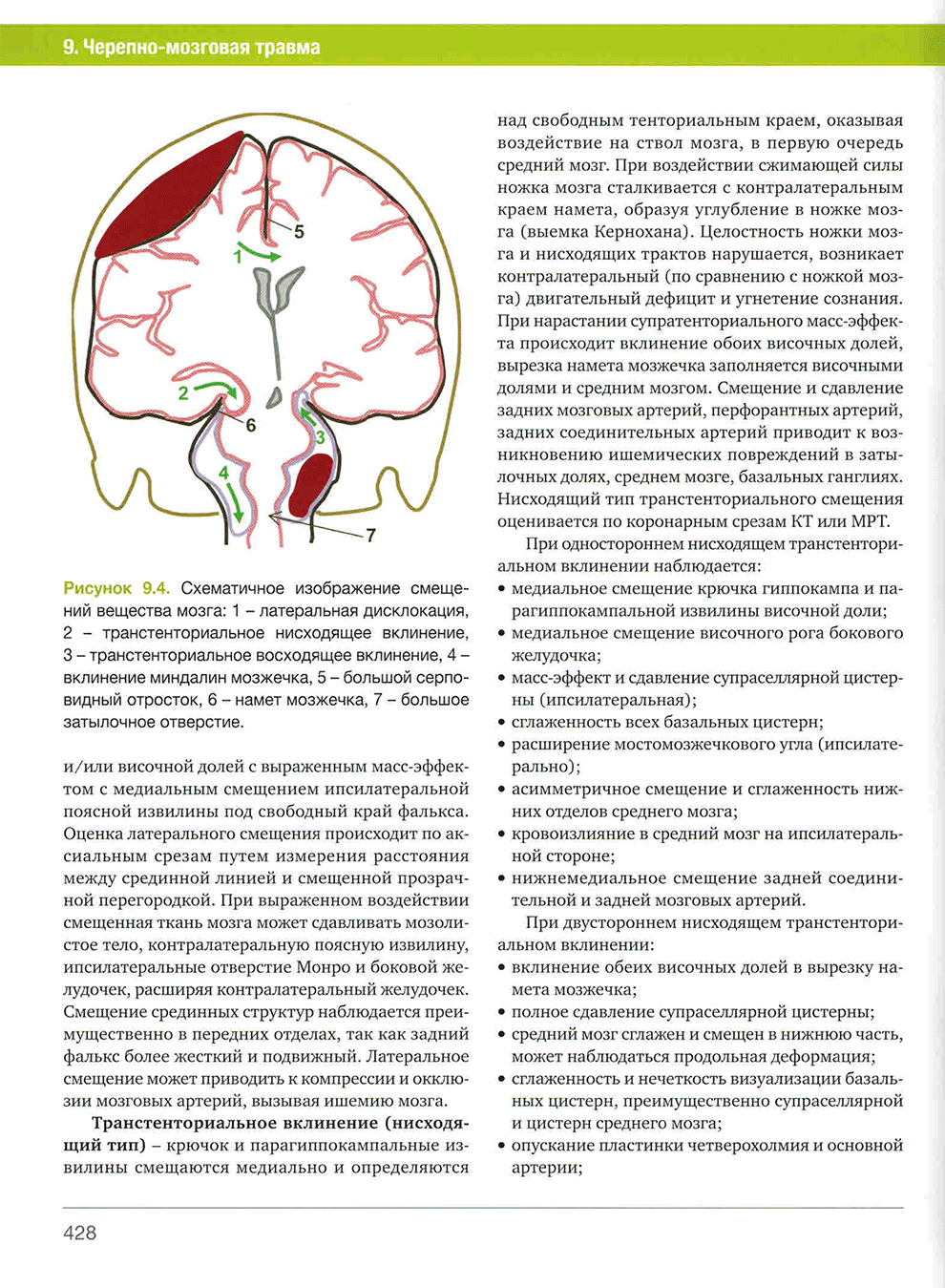 Рисунок 9.4. Схематичное изображение смещений вещества мозга