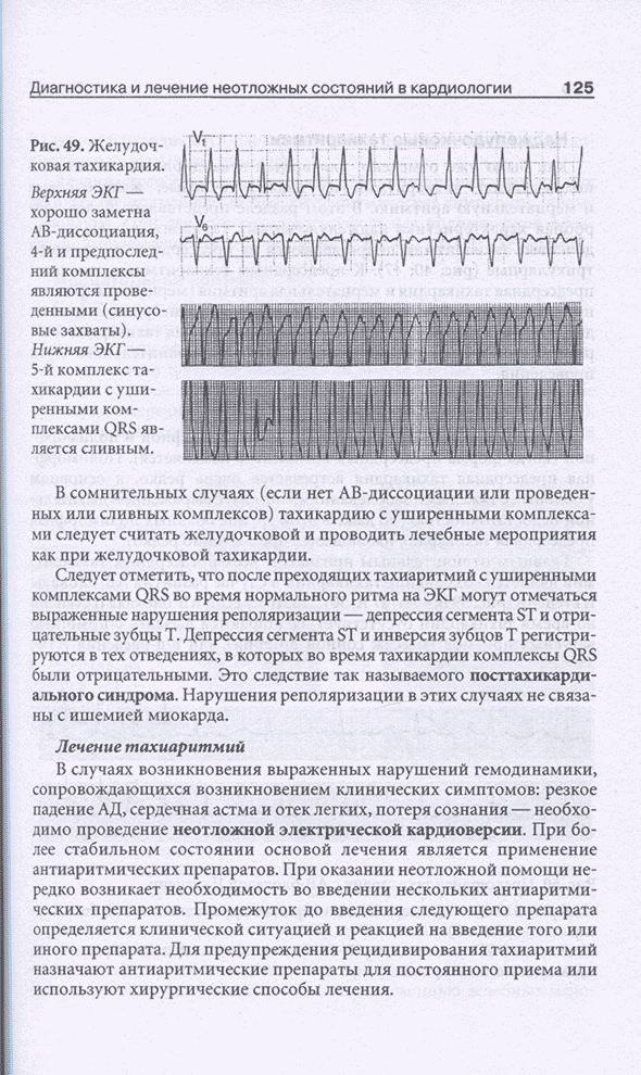 Рис. 49. Желудочковая тахикардия.