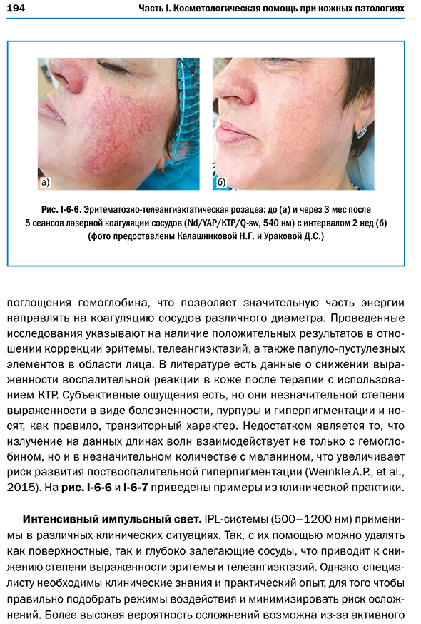 Эритематозно-телеангиэктатическая розацеа