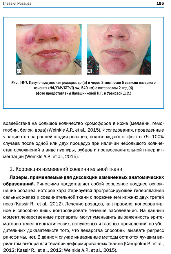 Папуло-пустулезная розацеа