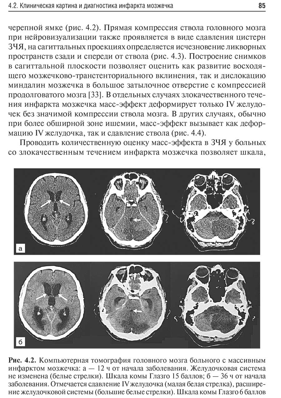 Рис. 4.2. Компьютерная томография головного мозга больного
