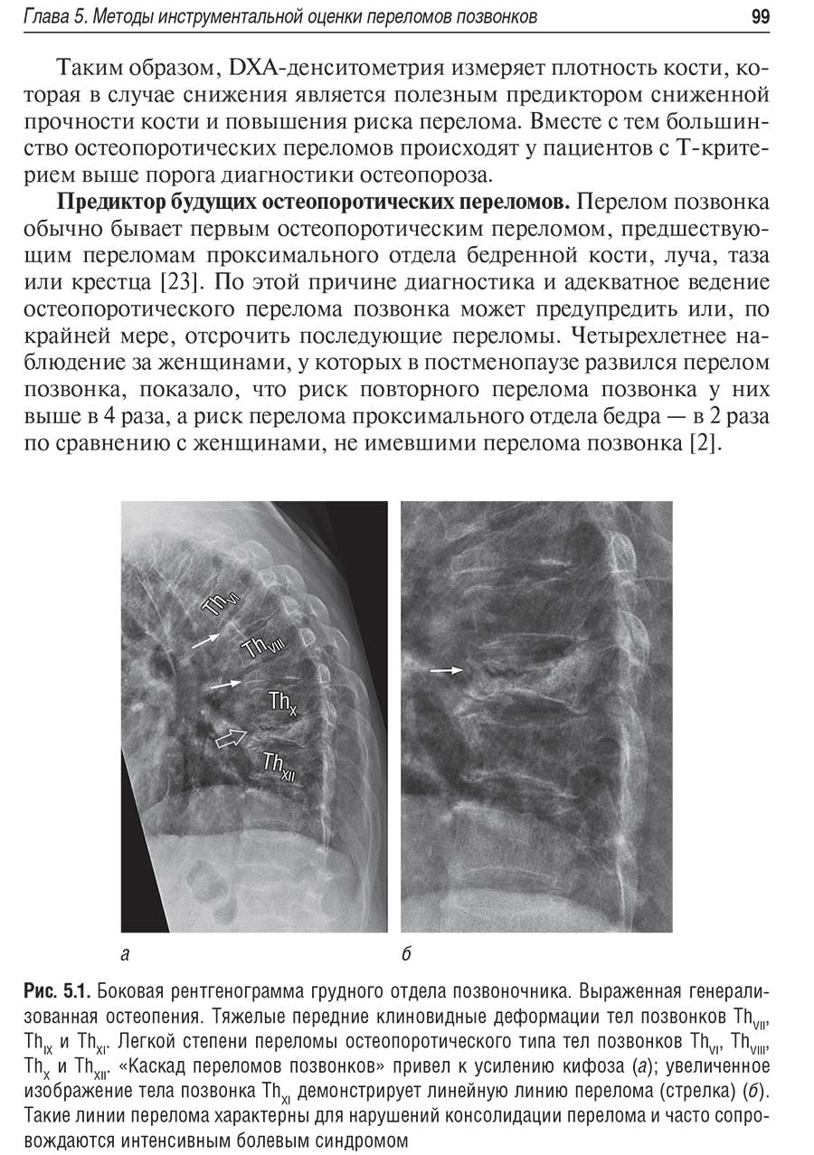 Рис. 5.1. Боковая рентгенограмма грудного отдела позвоночника.