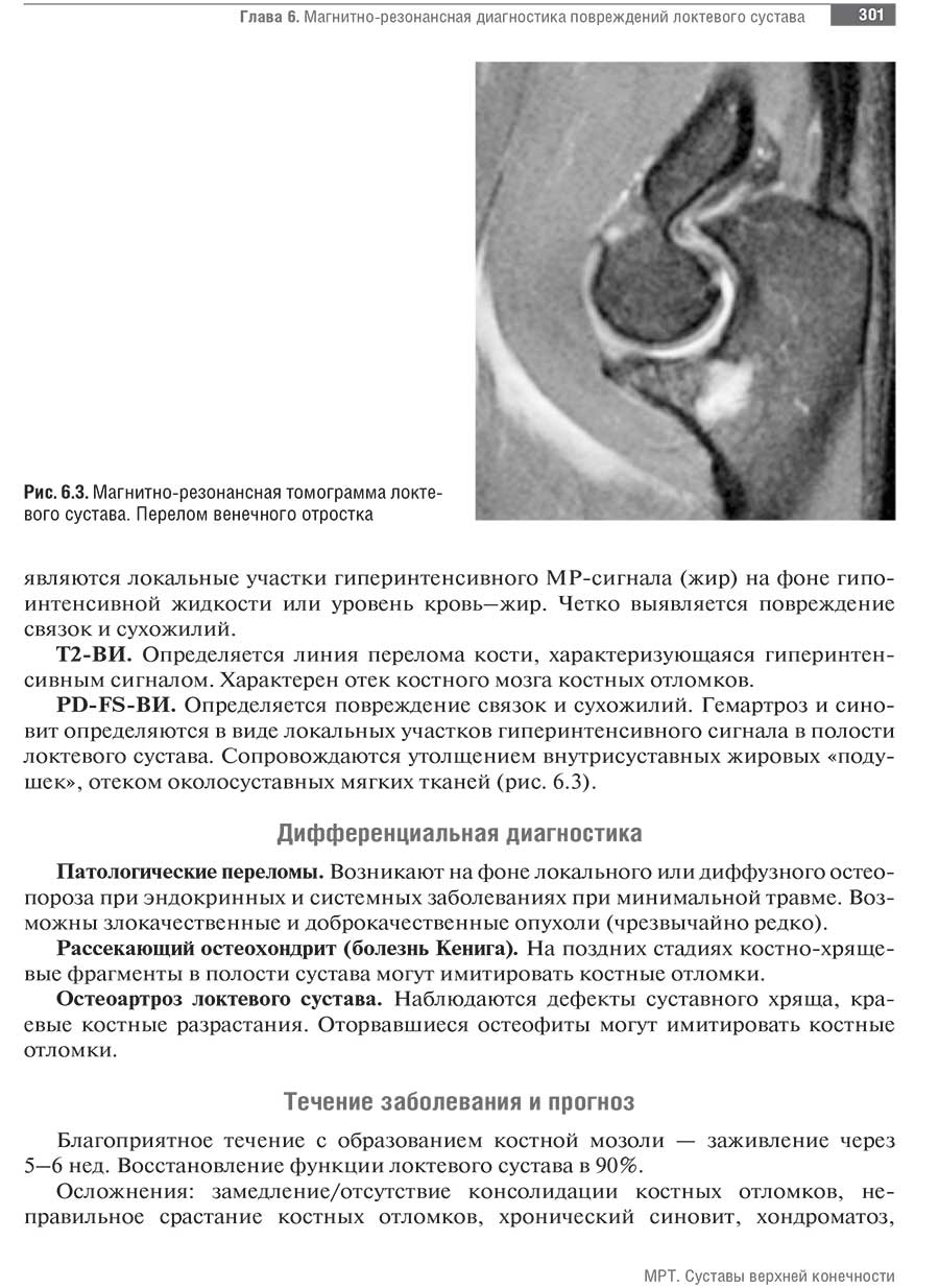 Рис. 6.3. Магнитно-резонансная томограмма локтевого сустава. Перелом венечного отростка