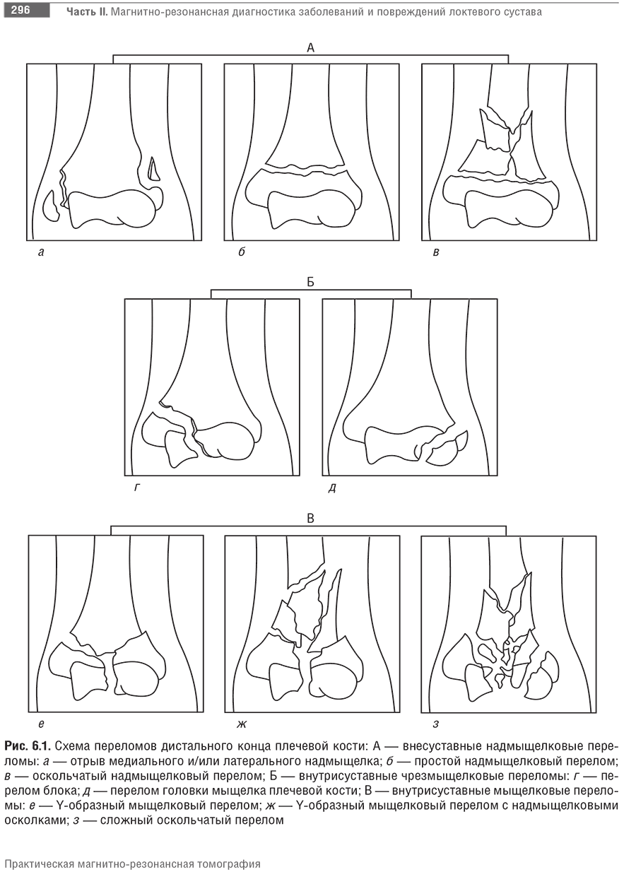 Схема переломов дистального конца плечевой кости