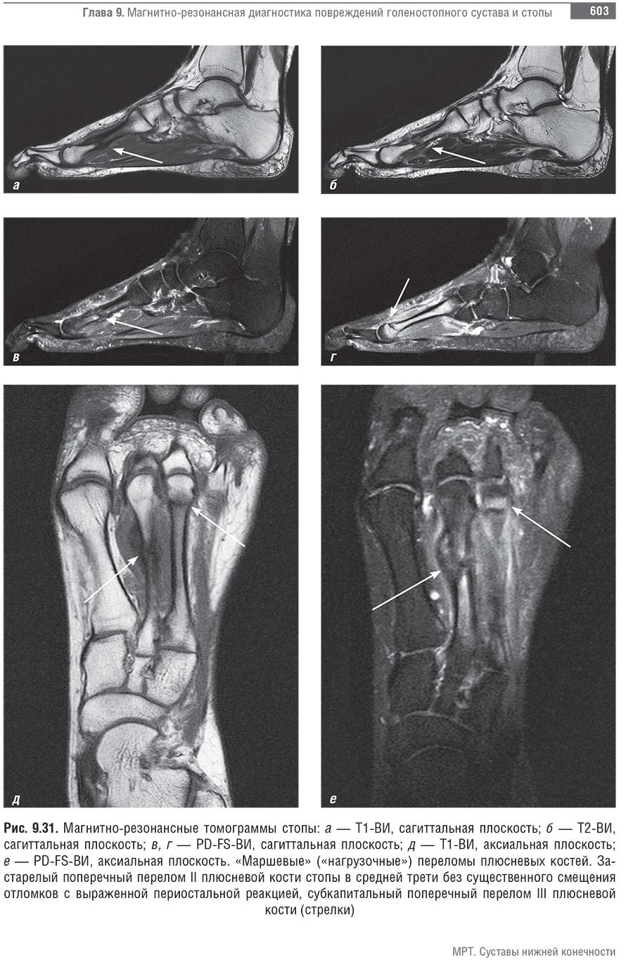 Магнитно-резонансные томограммы стопы