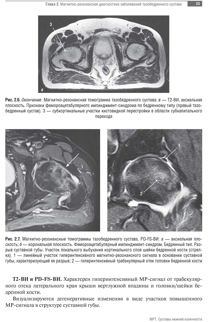 Магнитно-резонансные томограммы тазобедренного сустава