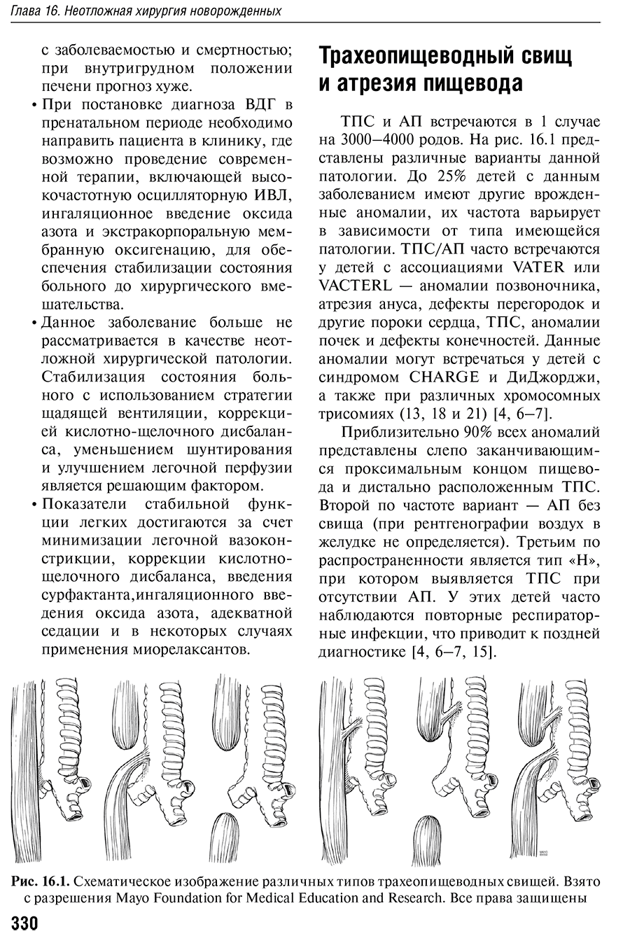 Рис. 16.1. Схематическое изображение различных типов трахеопищеводных свищей.