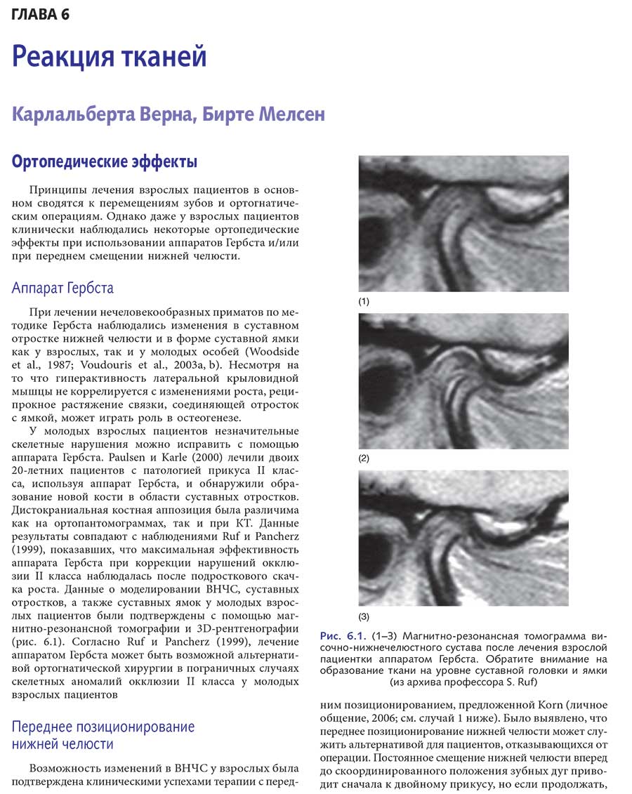 Рис. 6.1. (1—3) Магнитно-резонансная томограмма височно-нижнечелюстного сустава после лечения взрослой пациентки аппаратом Гербста
