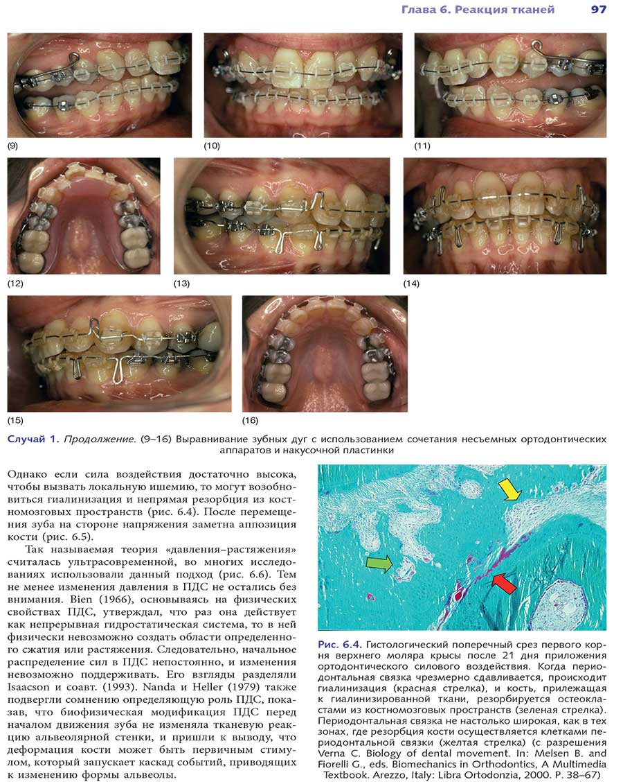 Выравнивание зубных дуг с использованием сочетания несъемных ортодонтических аппаратов и накусочной пластинки
