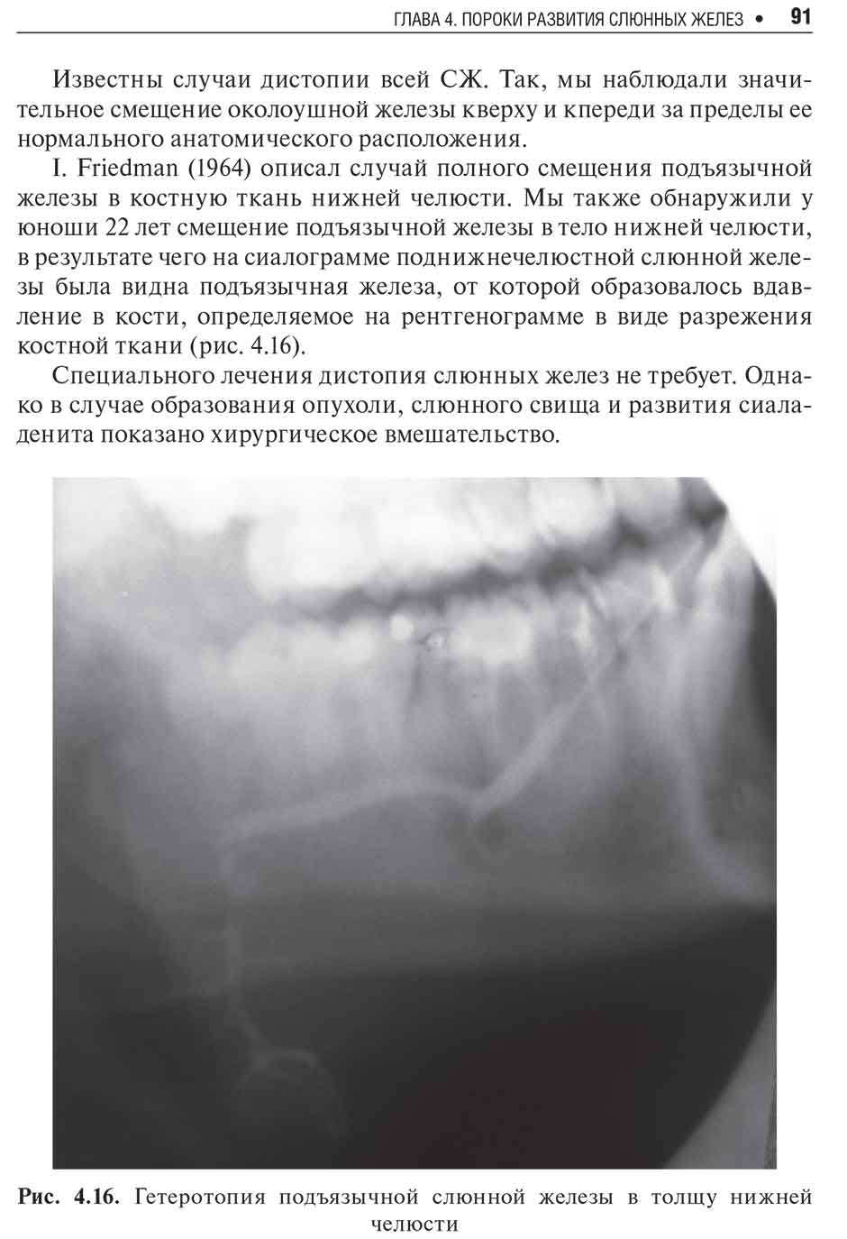 Рис. 4.16. Гетеротопия подъязычной слюнной железы в толщу нижней челюсти