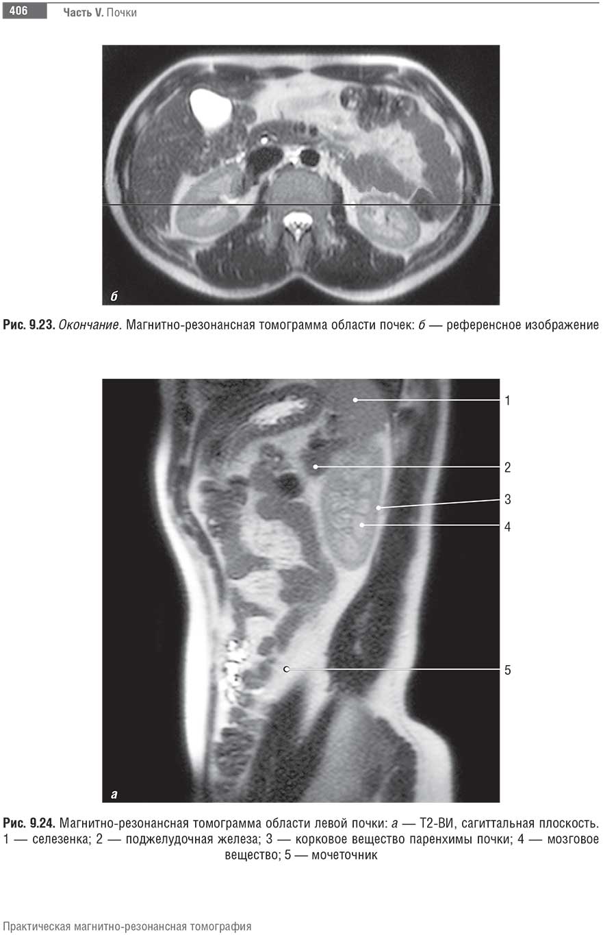Магнитно-резонансная томограмма области левой почки
