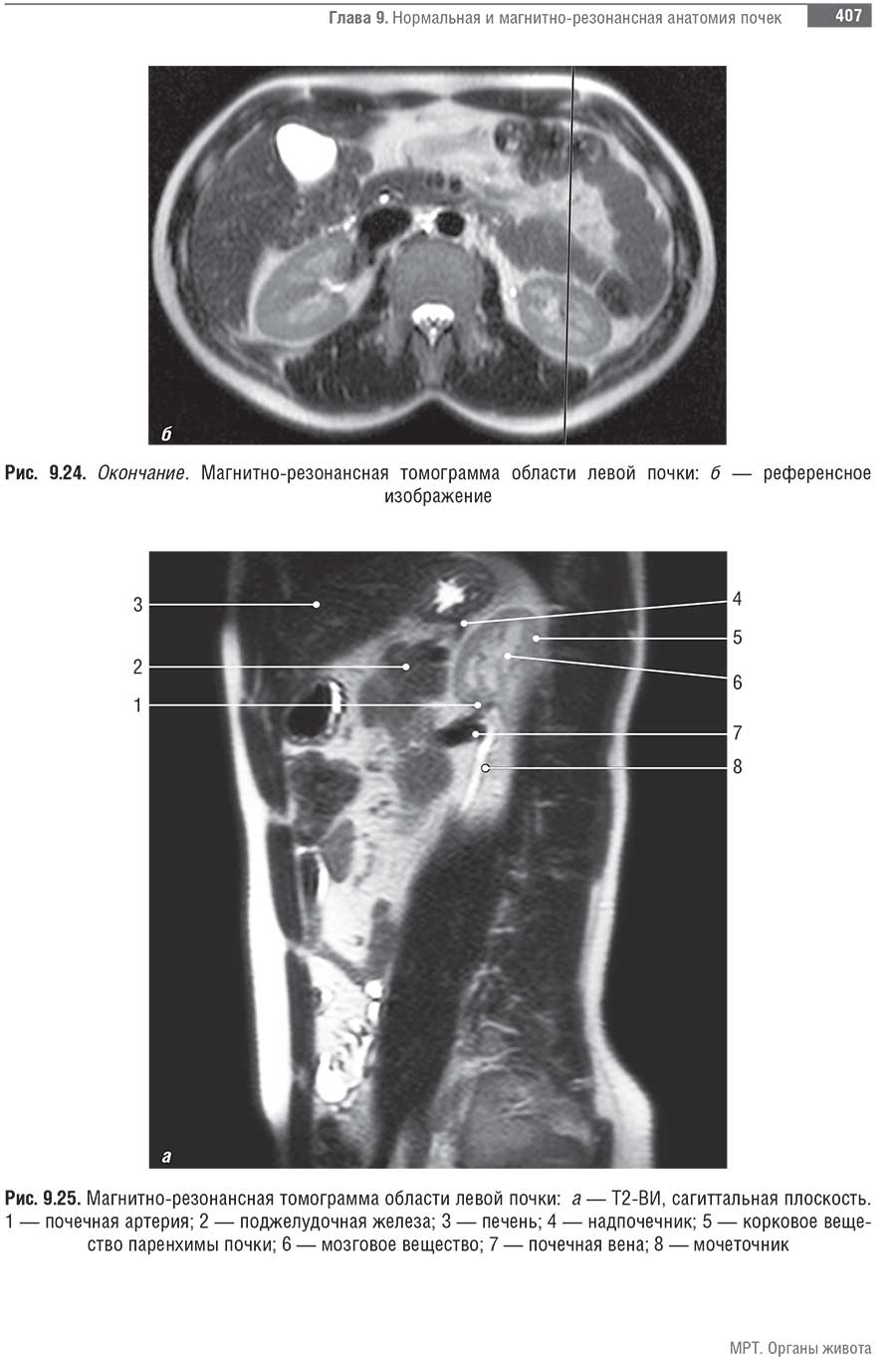 Магнитно-резонансная томограмма области левой почки