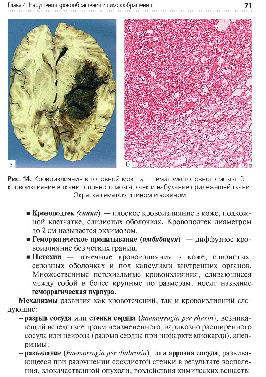 Кровоизлияние в головной мозг