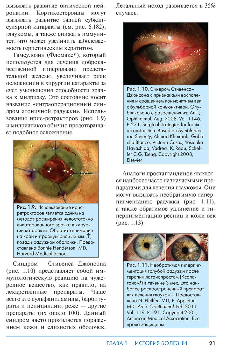 Рис. 1.9. Использование ирис-ретракторов является одним из методов расширения недостаточно дилатированного зрачка в хирургии катаракты