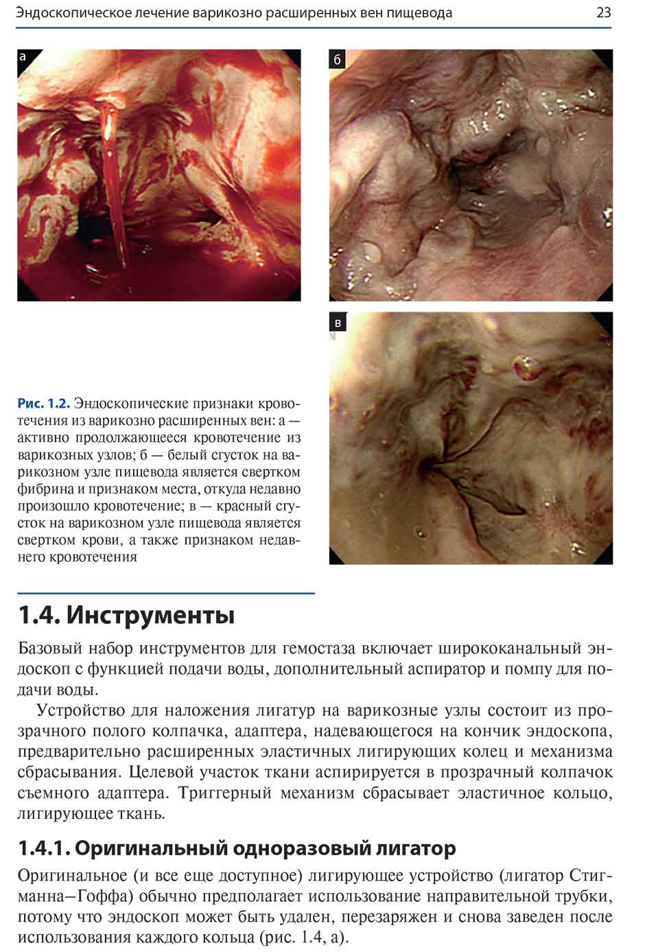 Рис. 1.2. Эндоскопические признаки кровотечения из варикозно расширенных вен