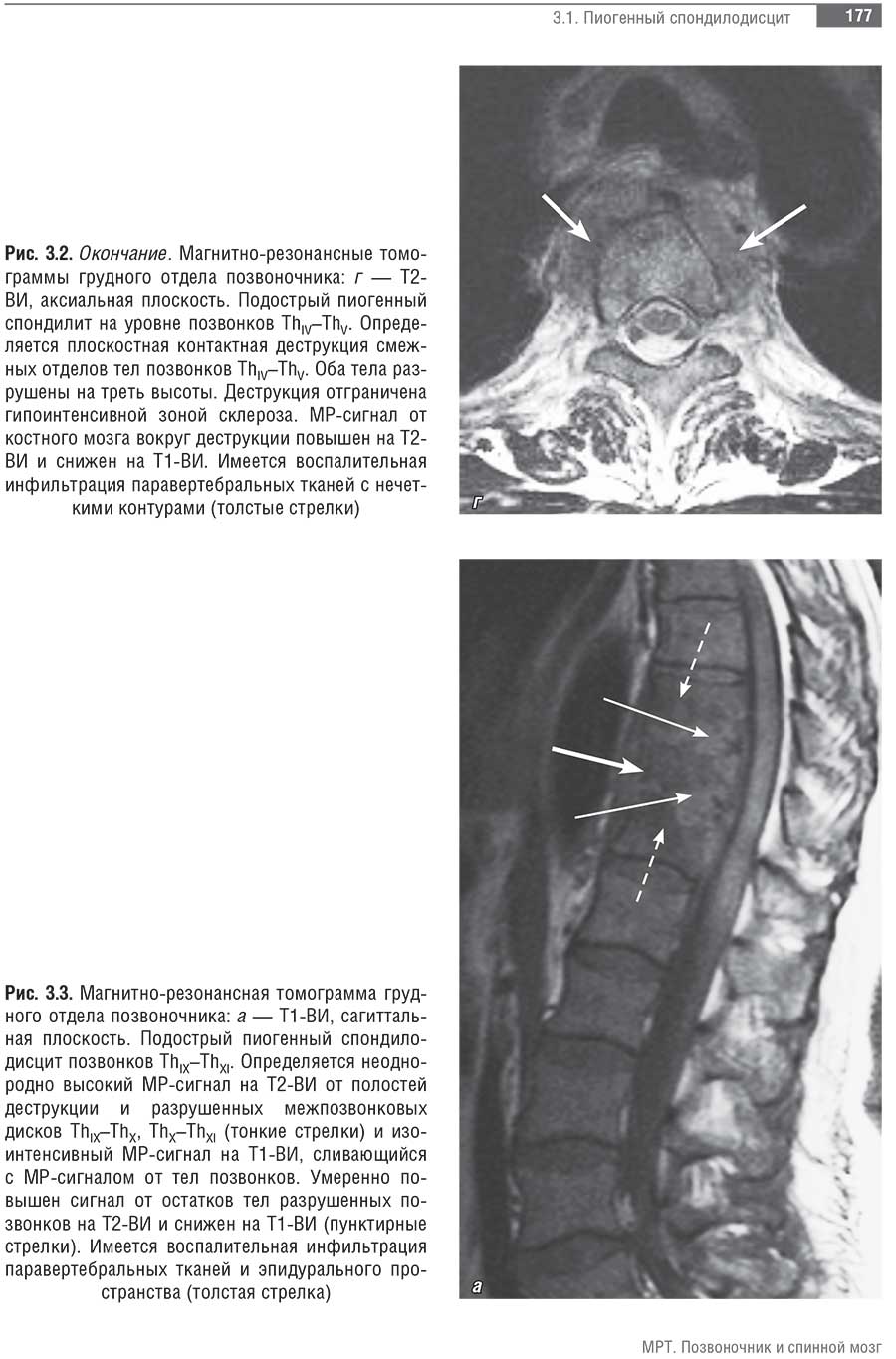 Рис. 3.3. Магнитно-резонансная томограмма грудного отдела позвоночника: а — Т1-ВИ