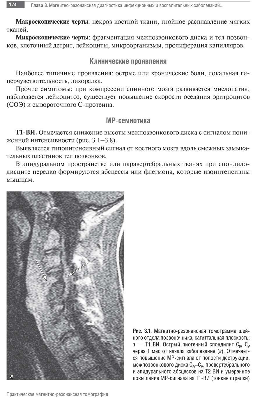 Рис. 3.1. Магнитно-резонансная томограмма шейного отдела позвоночника, сагиттальная плоскость