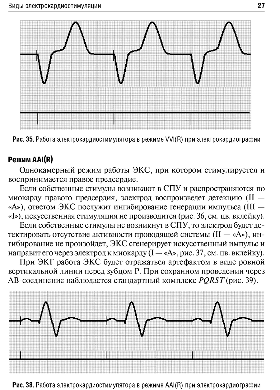 Рис. 35. Работа электрокардиостимулятора в режиме VVI(R) при электрокардиографии