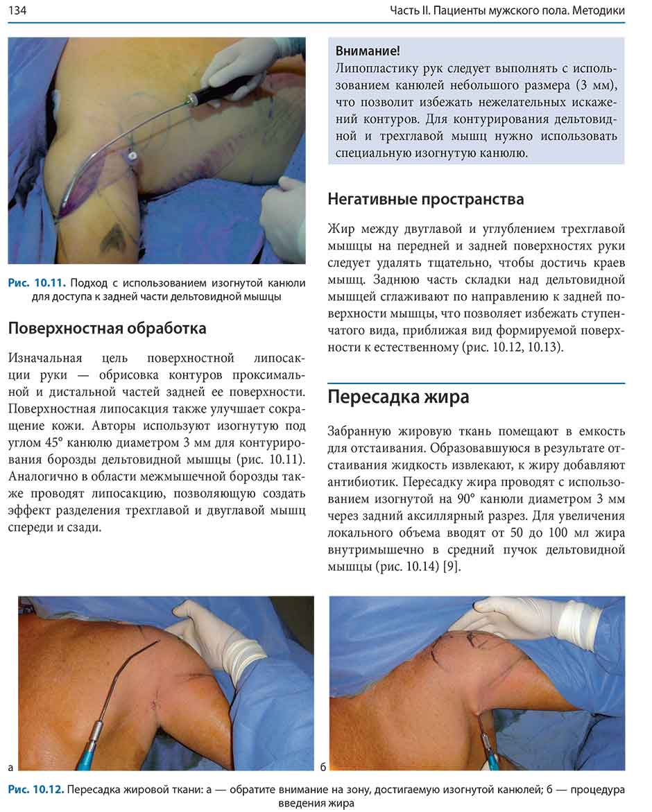 Рис. 10.12. Пересадка жировой ткани