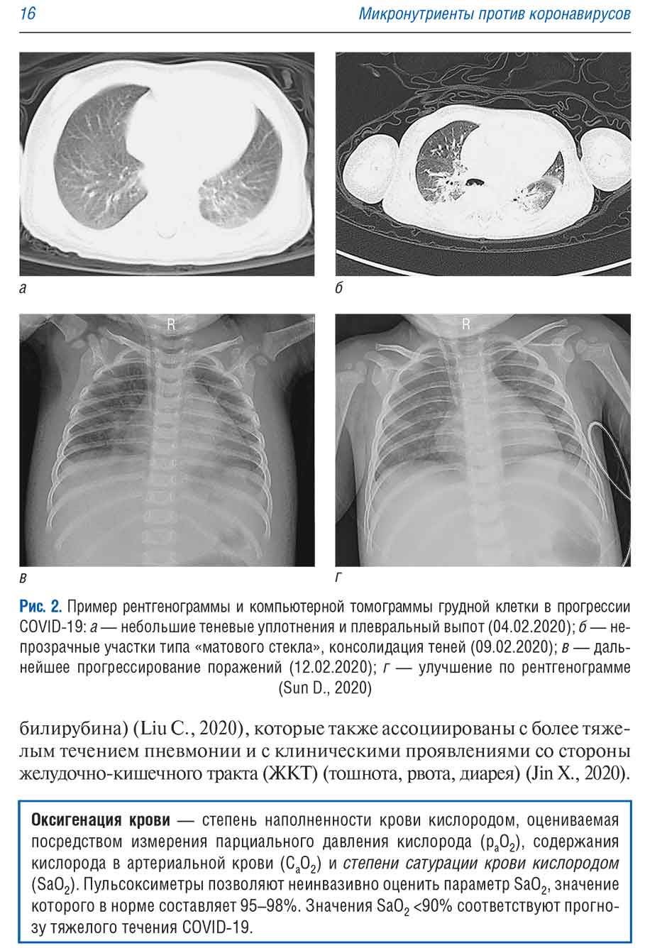 Рис. 2. Пример рентгенограммы и компьютерной томограммы грудной клетки в прогрессии