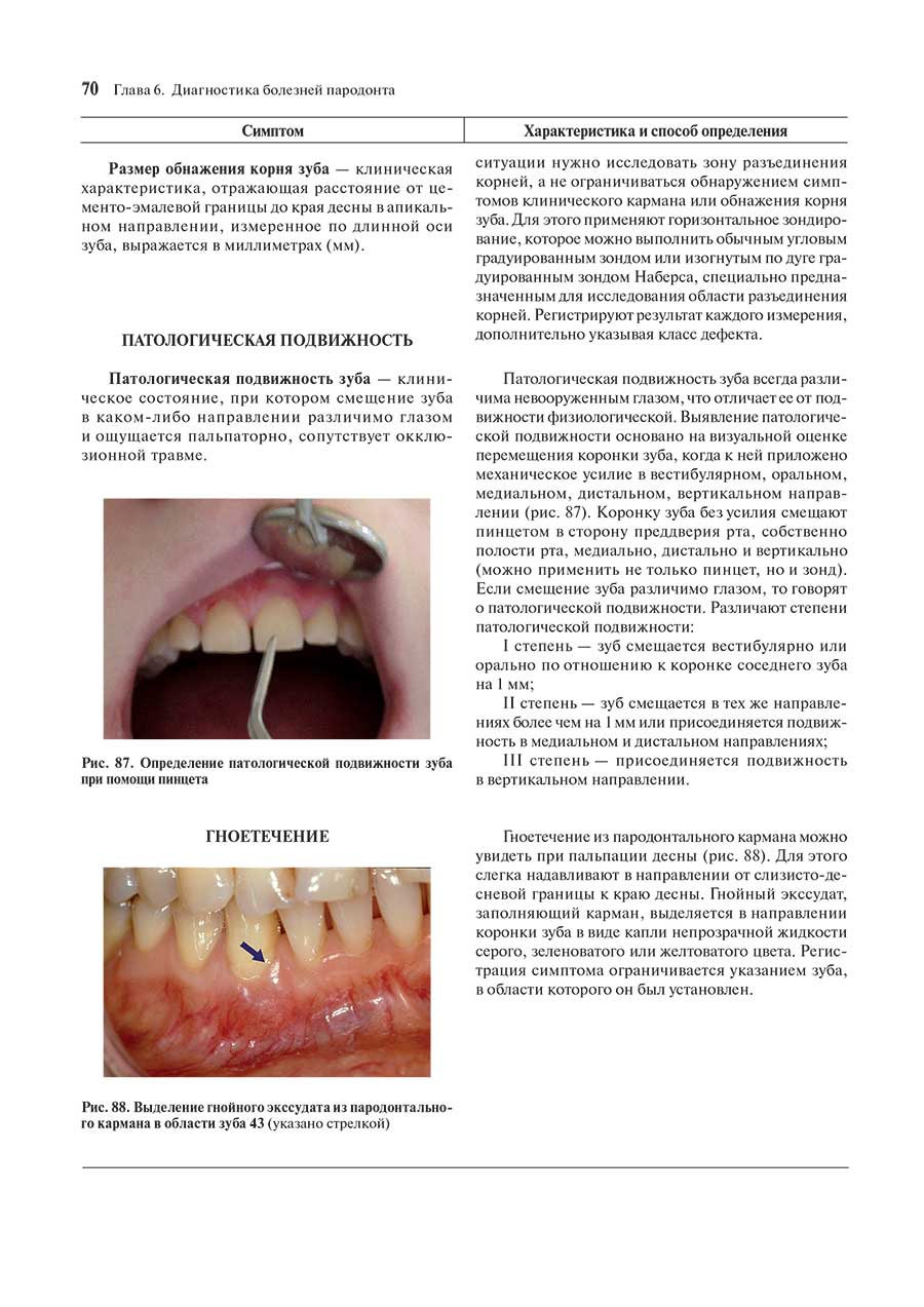 Рис_ 88. Выделение гнойного экссудата из пародонтального кармана в области зуба 43 (указано стрелкой)