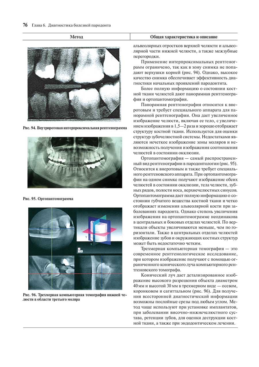 Рис. 96. Трехмерная компьютерная томография нижней челюсти в области третьего моляра