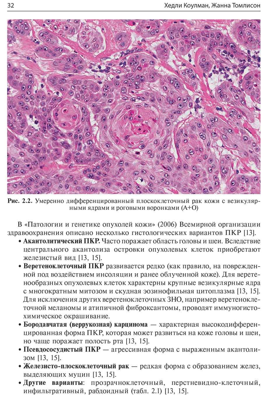 Рис. 2.2. Умеренно дифференцированный плоскоклеточный рак кожи с везикулярными ядрами и роговыми воронками (А+О)