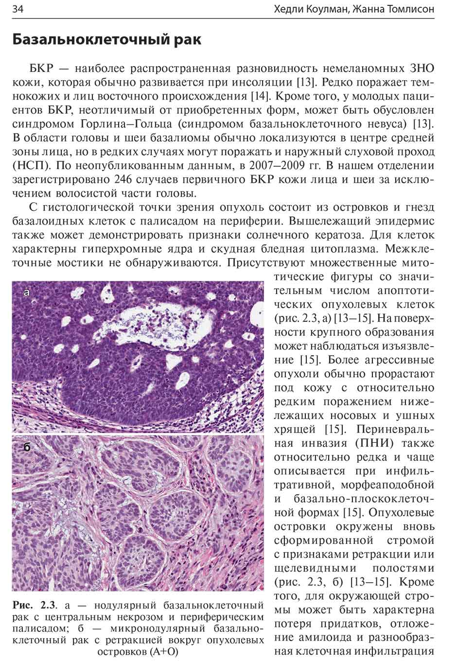 Рис. 2.3. а — нодулярный базальноклеточный рак с центральным некрозом и периферическим палисадом