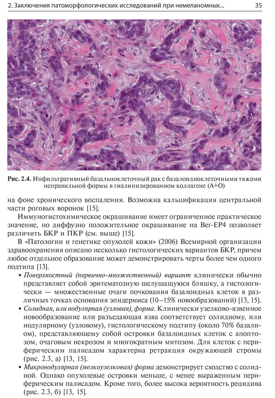 Рис. 2.4. Инфильтративный базальноклеточный раке базалоидноклеточными тяжами неправильной формы в гиалинизированном коллагене (А+О)