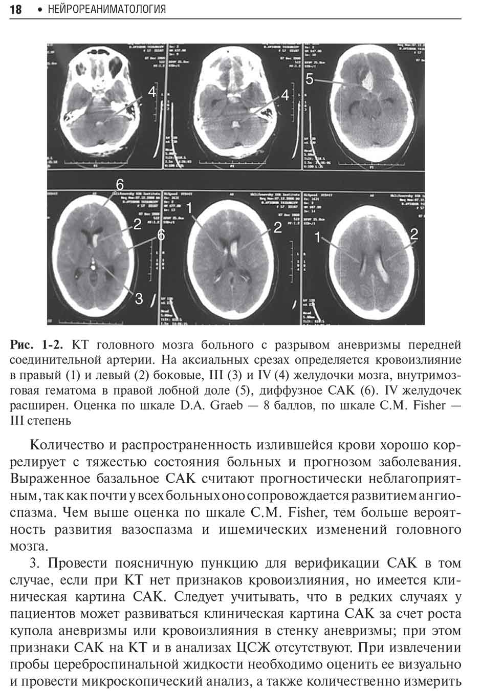 Рис. 1-2. КТ головного мозга больного с разрывом аневризмы