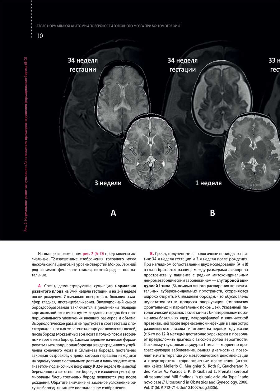(А-D) представлены аксиальные Т2-взвешенные изображения головного мозга