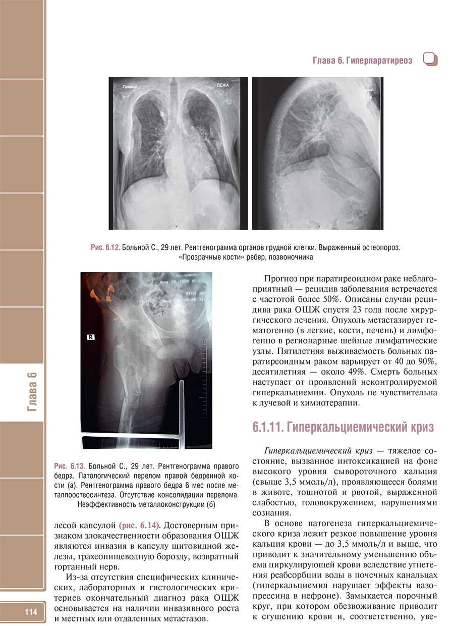 Рис. 6.12 Больной С.. 29 лет. Рентгенограмма органов грудной клетки