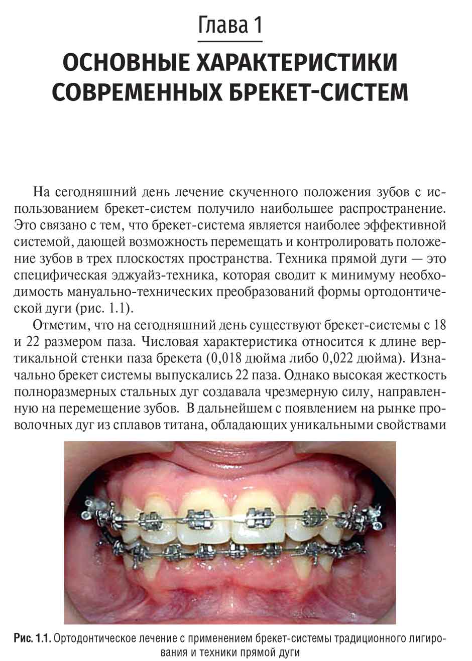 Рис. 1.1. Ортодонтическое лечение с применением брекет-системы традиционного лигирования и техники прямой дуги