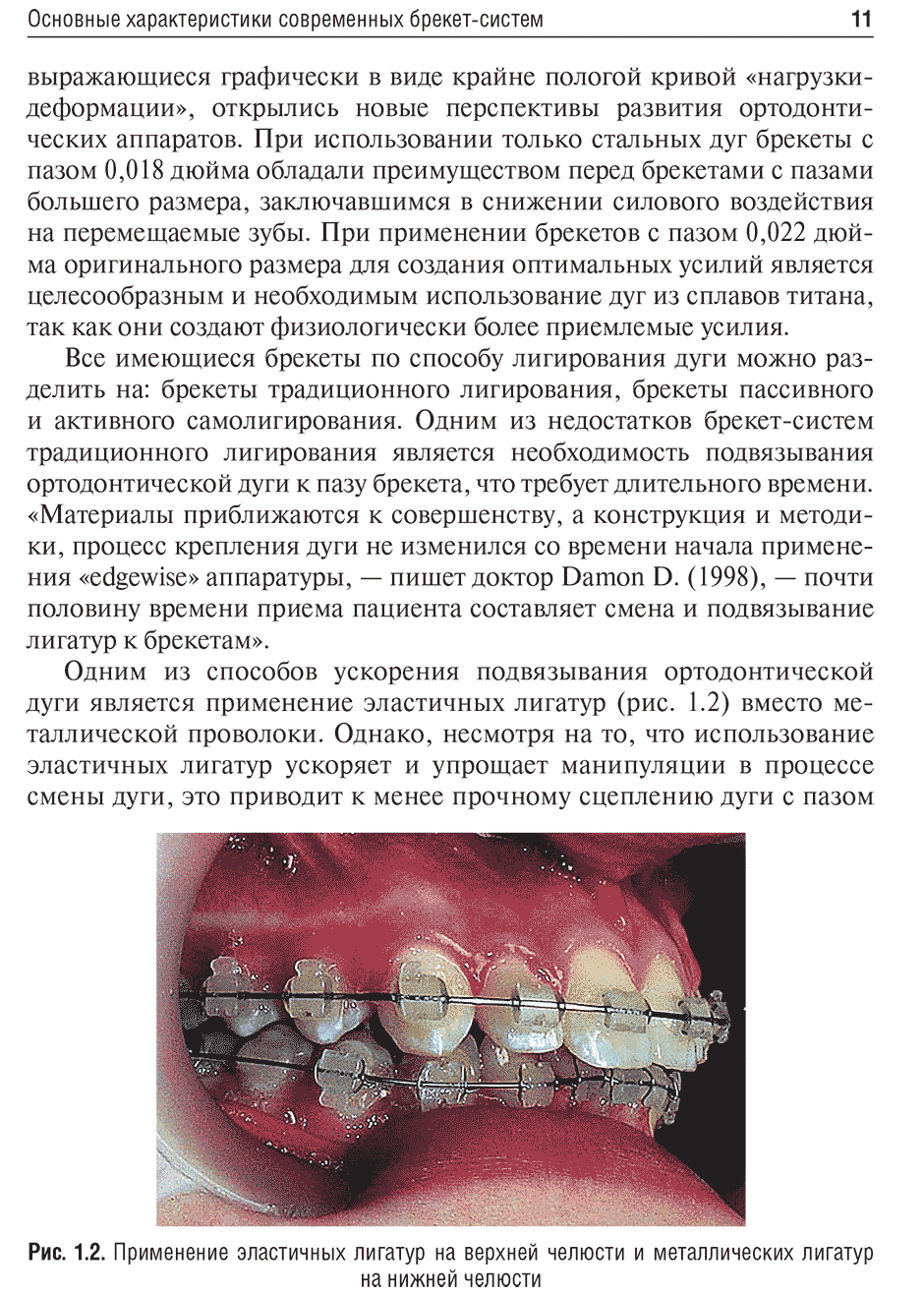 Рис. 1.2. Применение эластичных лигатур на верхней челюсти и металлических лигатур на нижней челюсти