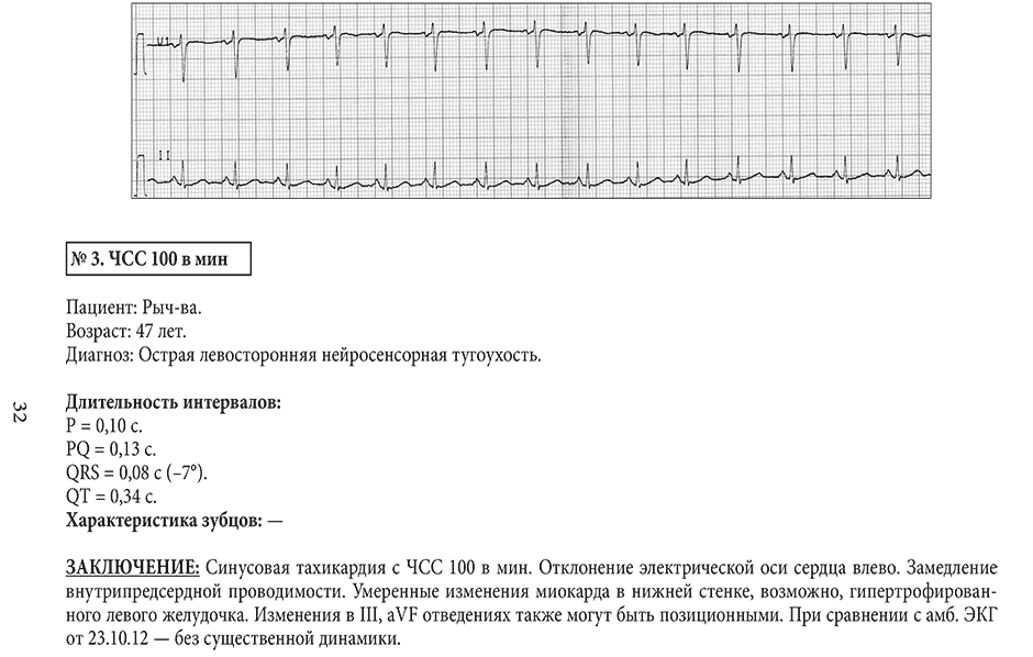Заключение: Синусовая тахикардия с ЧСС 100 в мин. Отклонение электрической оси сердца влево.