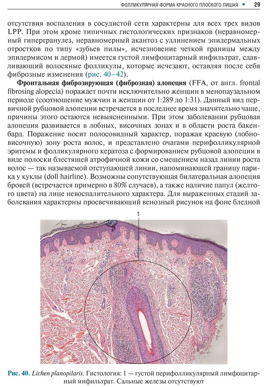 Рис. 40. Lichen planopilaris. Гистология: 1 — густой перифолликулярный лимфоцитарный инфильтрат. Сальные железы отсутствуют