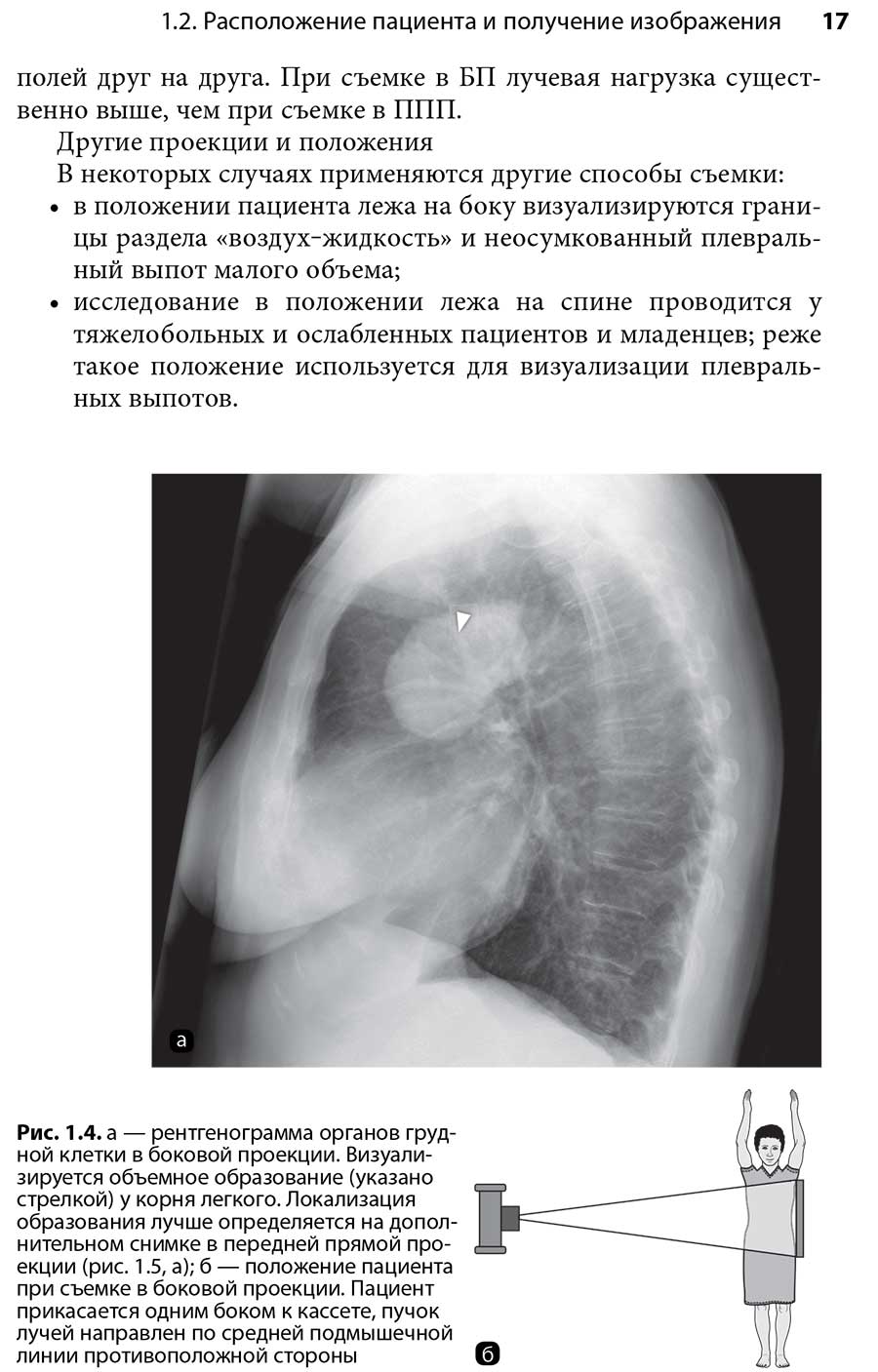 Рис. 1.4. а — рентгенограмма органов грудной клетки в боковой проекции. Визуализируется объемное образование (указано стрелкой) у корня легкого