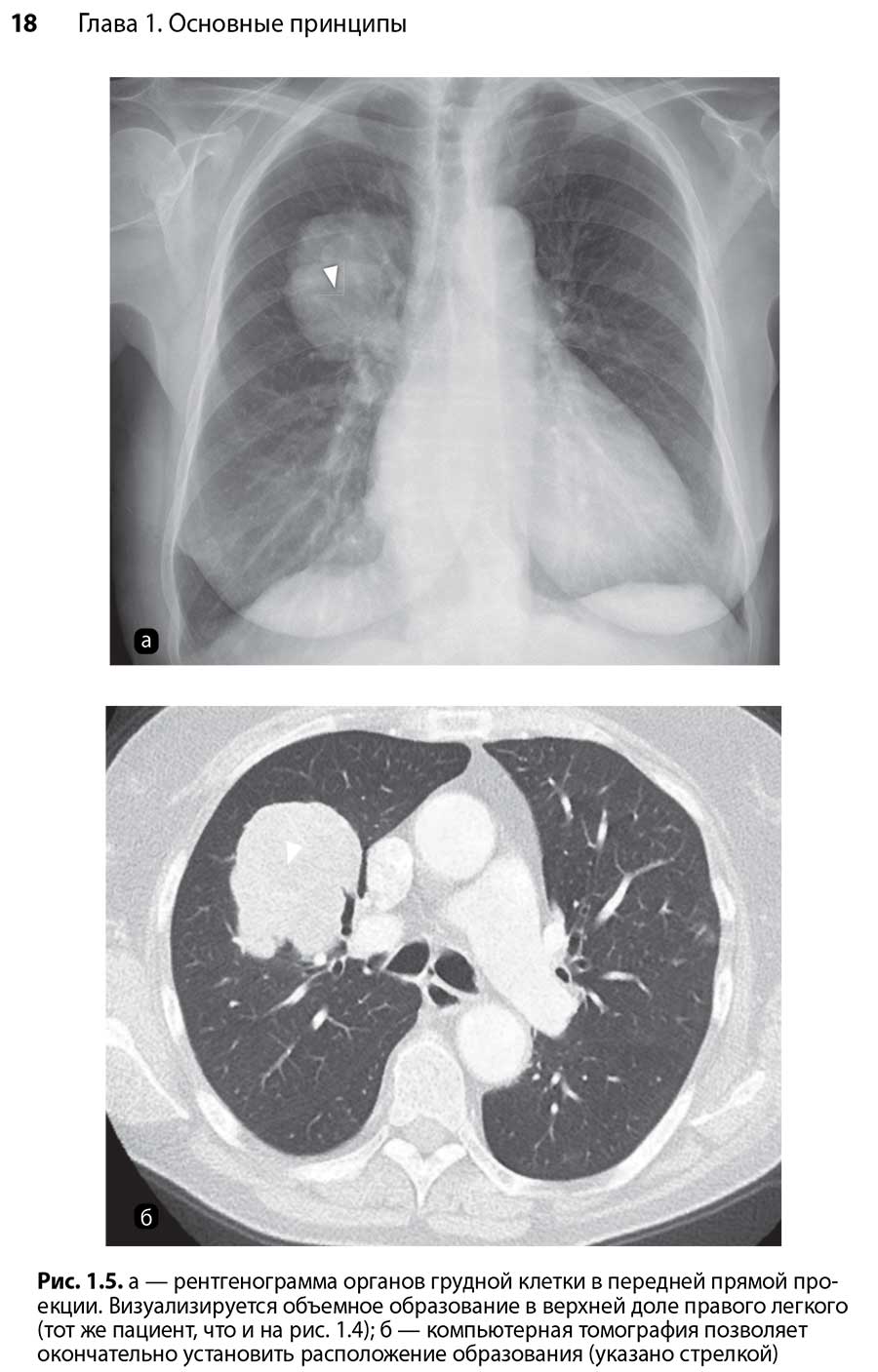 Рис. 1.5. а — рентгенограмма органов грудной клетки в передней прямой проекции