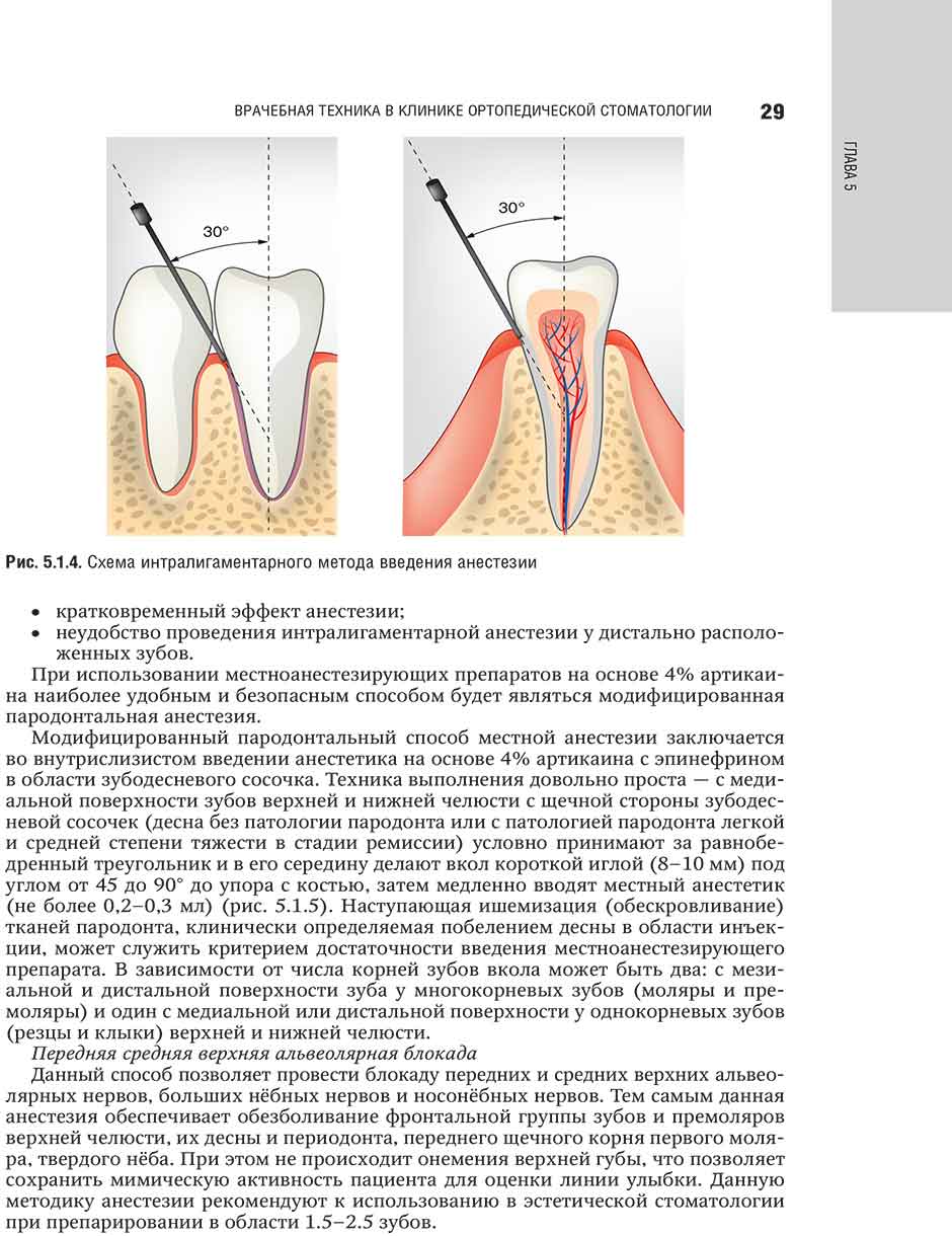 Рис. 5.1.4. Схема интралигаментарного метода введения анестезии