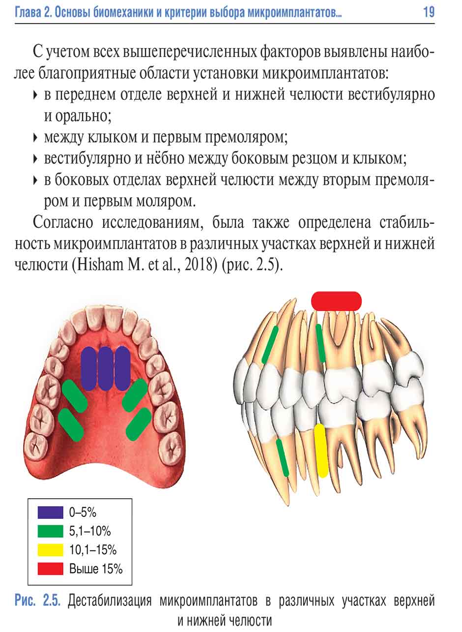 Рис. 2.5. Дестабилизация микроимплантатов в различных участках верхней и нижней челюсти