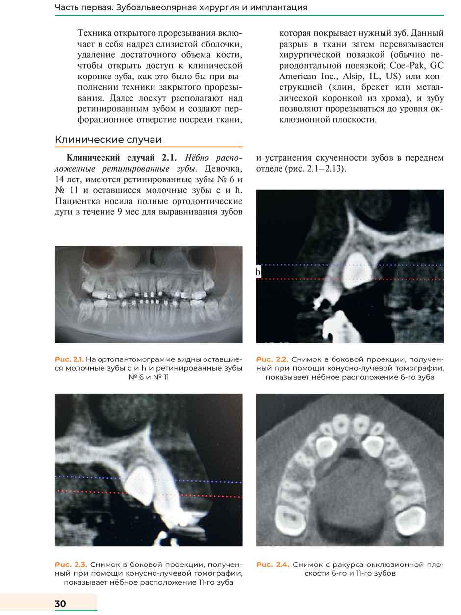 Рис. 2.4 Снимок с ракурса окклюзионной плоскости 6-го и 11-го зубов