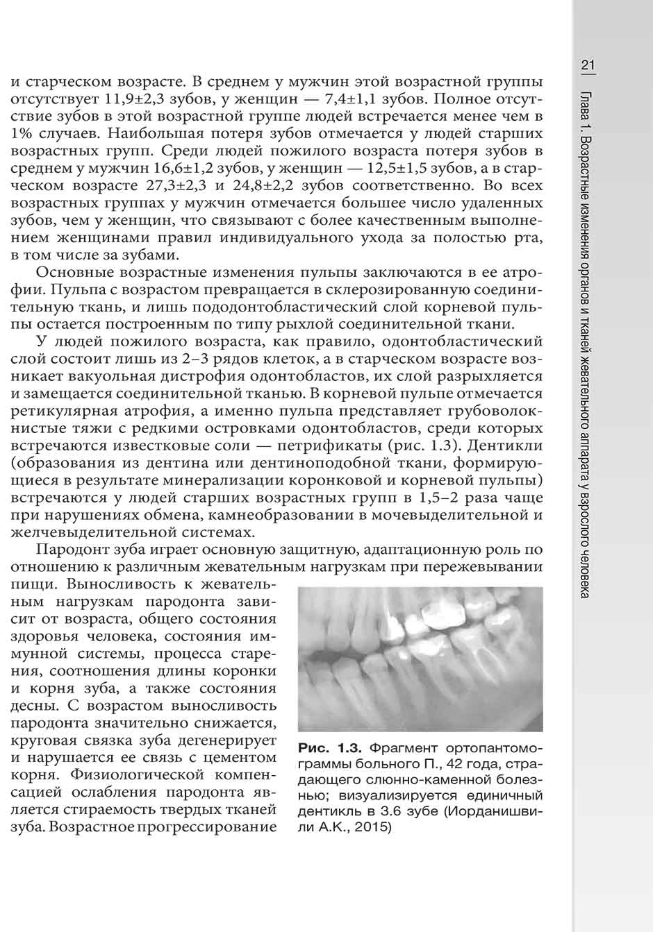 Рис. 1.3. Фрагмент ортопантомограммы больного П., 42 года, страдающего слюнно-каменной болезнью; визуализируется единичный