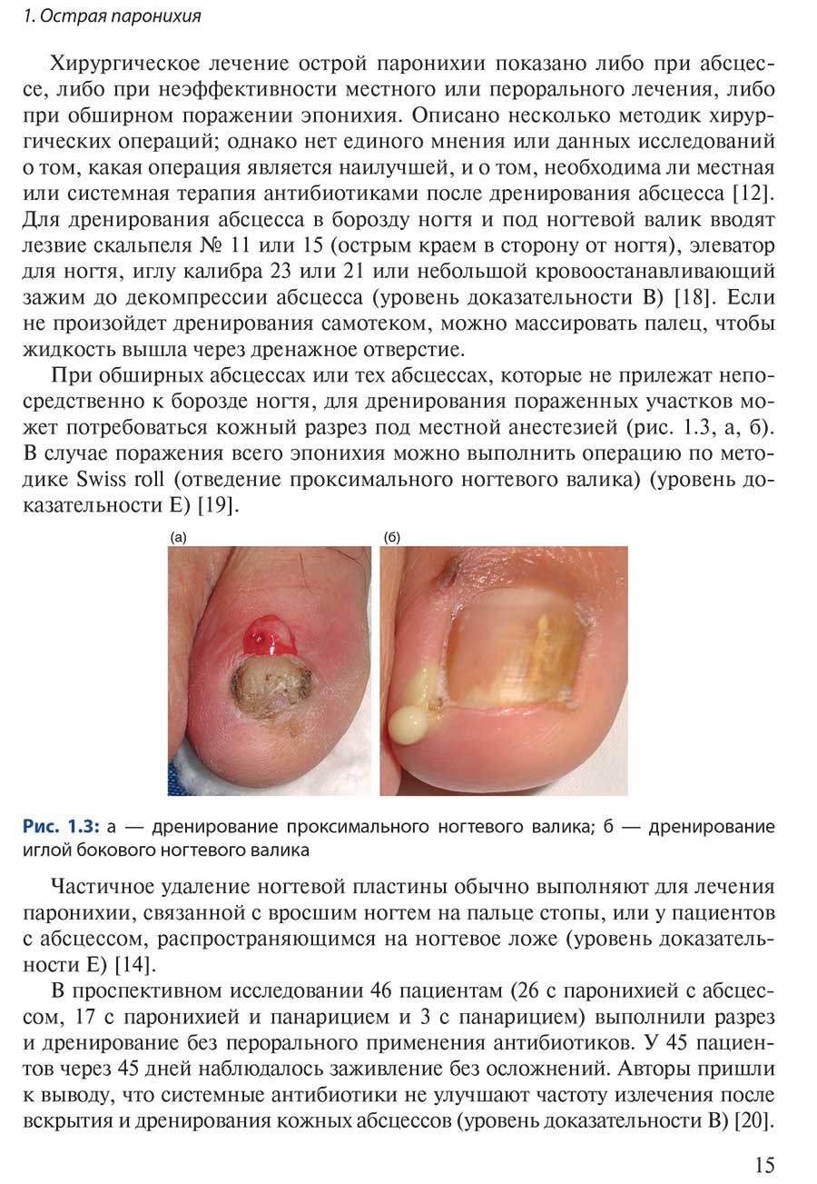Рис. 1.3: а — дренирование проксимального ногтевого валика
