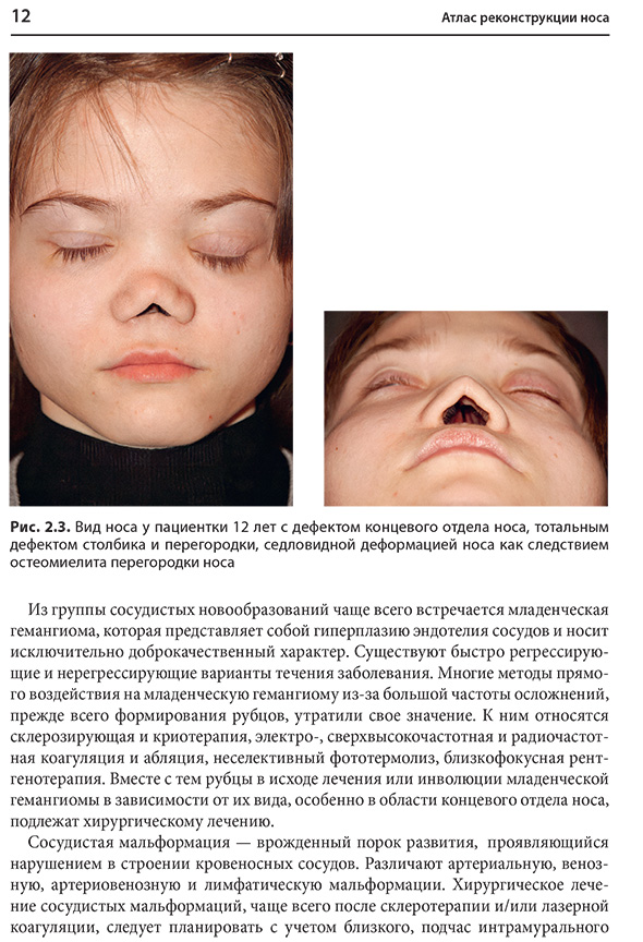 Рис. 2.3. Вид носа у пациентки 12 лет с дефектом концевого отдела носа