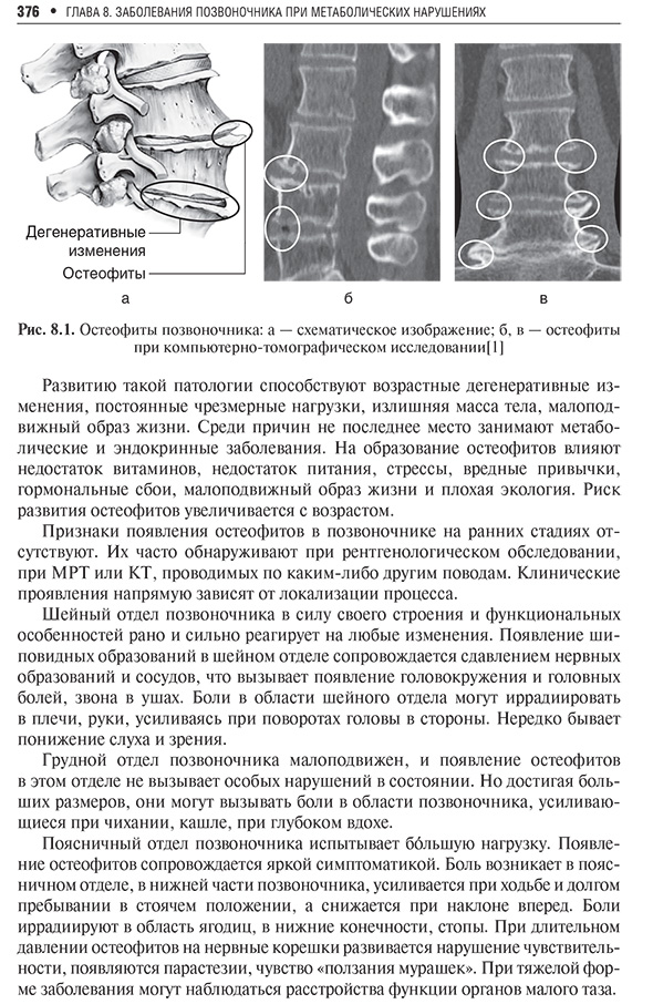 Остеофиты позвоночника Остеофиты позвоночника