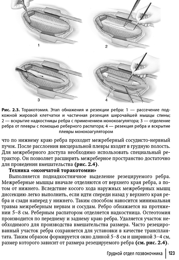 Торакотомия. Этап обнажения и резекции ребра Торакотомия. Этап обнажения и резекции ребра